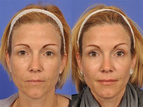 Botox Before And After 1 Misbiw ⎮ Medical Innovative