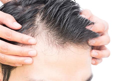 minoxidil hair loss outlets  save  jlcatjgobmx
