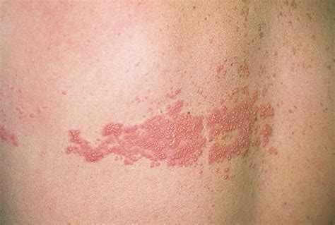 shingles rash pictures sexy fucking images