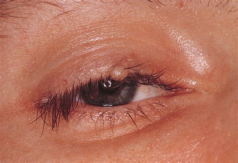 eyelid nodule  sentinel lesion  disseminated cryptococcosis   patient  acquired