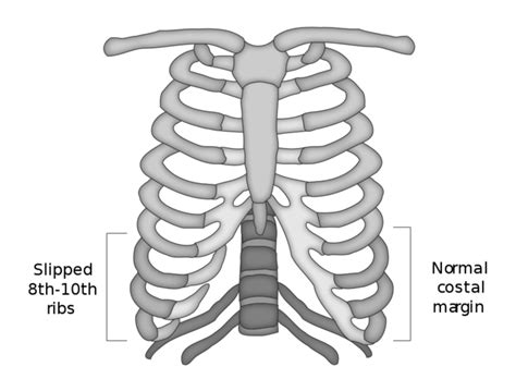 Slipping Rib Syndrome Physiopedia