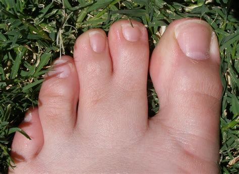 Syndactyly Of The Toes Pediatrics Orthobullets