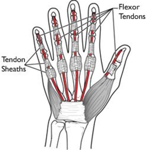 severed flexor tendon   pinky finger healdove