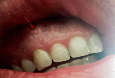 white bump   gums rdentistry