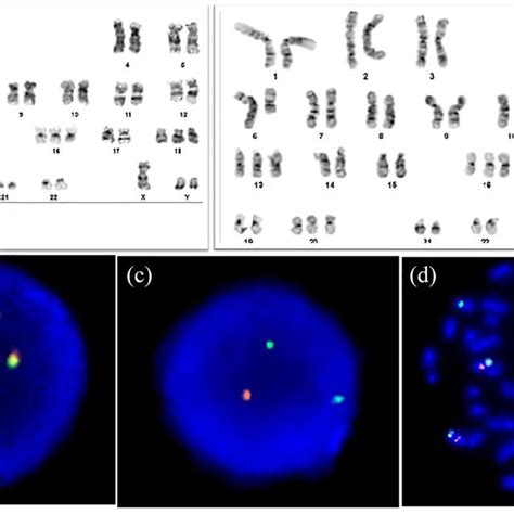 Cytogenetic Analysis Of G Banded Chromosomes For Cultured Bone Marrow