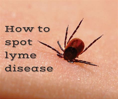 Beware The Tick Bite Prevention And Early Signs You May Have Lyme