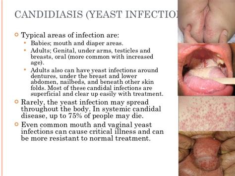 Male Yeast Infection Discharge Remedy Yeast Infection Swollen Testicle