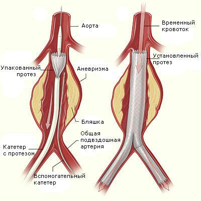 aneurysma aorta symptome und behandlung