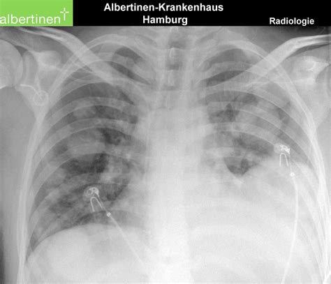 roe thorax lungenmetastasen doccheck