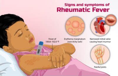 rheumatic fever concise medical knowledge