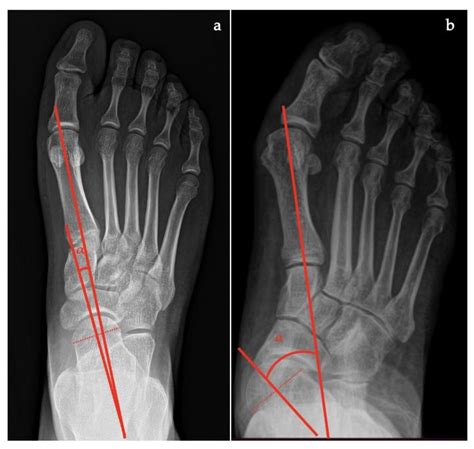 diagnostics  full text adult acquired flatfoot deformity