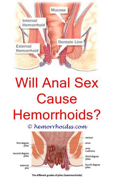 how does excercising improve hemorrhoid can you drink