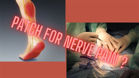 nerve pain  surgery   game changing option  successful recovery youtube