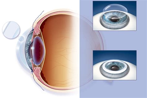 cornea  important   vision