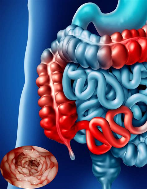 crohns disease  challenge  separating  potential  httpsdebugliescom