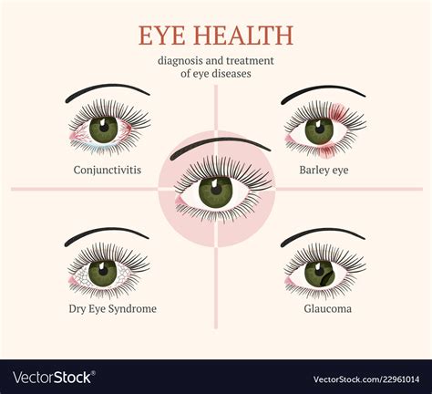 Most Common Eye Problems Royalty Free Vector Image