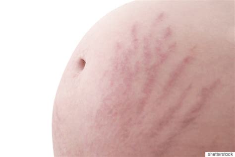 did you suffer from stretch marks during pregnancy