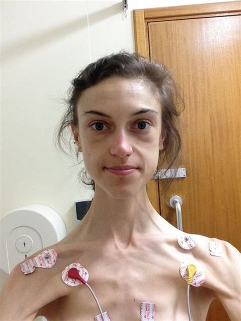 Anorexia Survivor Who Weighed Just 5st Shares Pictures Of