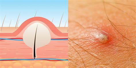 everything you need to know about ingrown hairs self