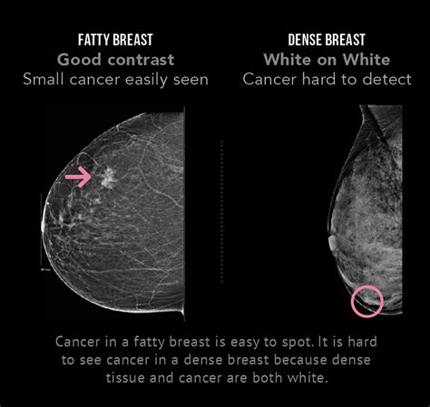 breast density canadian cancer survivor network