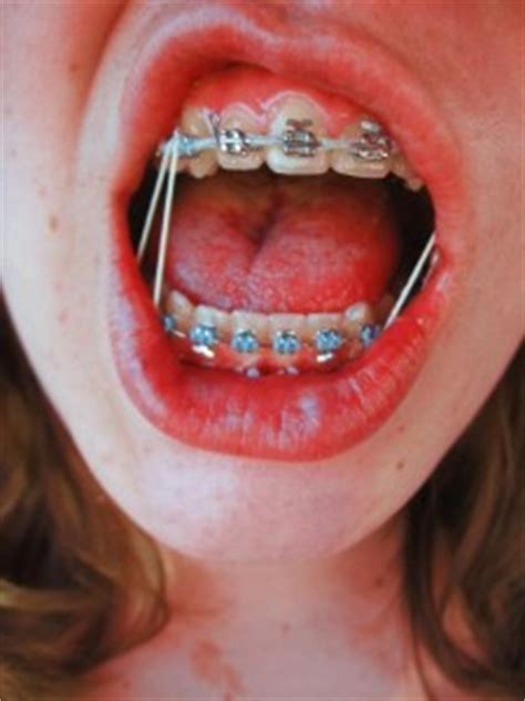 braces rubber bands purpose effects downsides results