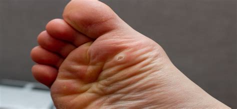 duct tape and plantar warts good health
