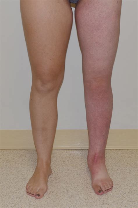 suction assisted protein lipectomy sapl   treatment  chronic lymphedema lymphedema blog