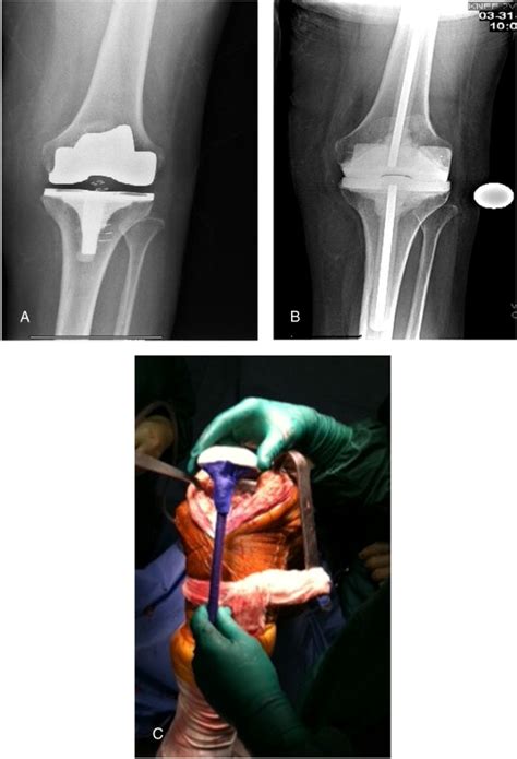 preformed articulating knee spacers   stage total knee revision