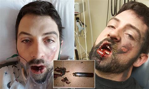 idaho man loses his teeth after vape explodes in his face daily mail