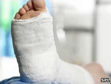 plaster cast   sprains  choice  news