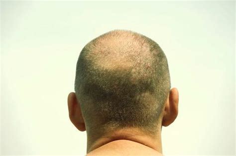 Going Bald You May Face A Higher Risk Of Aggressive Prostate Cancer