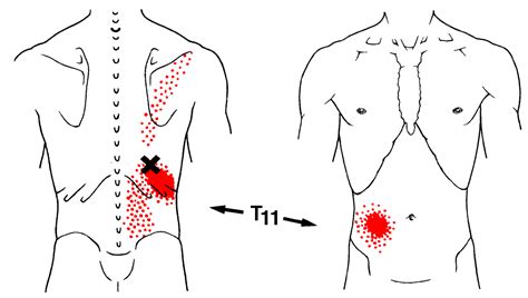Iliocostalis Thoracis The Trigger Point And Referred Pain