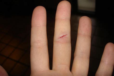 pflumpfamily  cut  finger