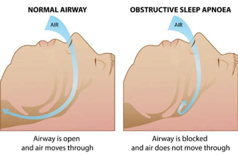 Obstructive Sleep Apnoea Asthma Foundation Nz