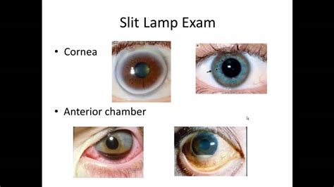 basic eye exam part ii slit lamp exam youtube