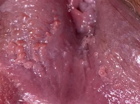 Is This Genital Warts Or Vp Graphic Photos Sexual