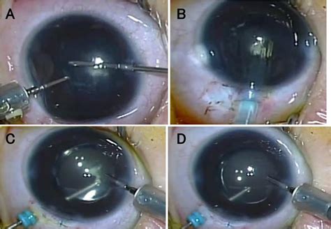 Intraocular Lens Implantation In Unilateral Congenital