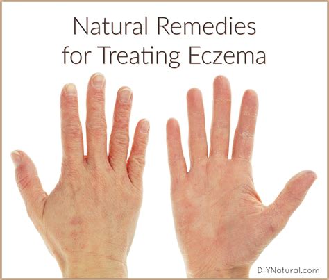 natural remedies  eczema  internal  external tips