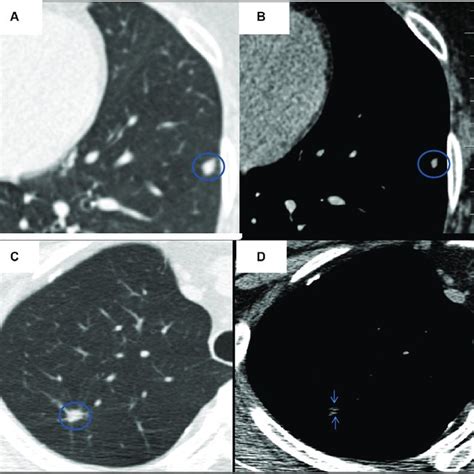 Comparison Of Two Mediastinal Features Between Benign And Malignant