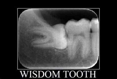 impacted wisdom tooth  pericoronitis