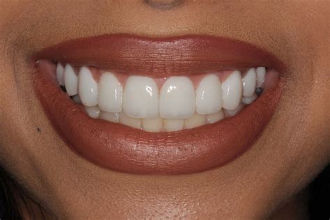 smile gallery    burbank dental lab