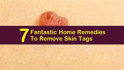 how to safely remove skin tags with home remedies