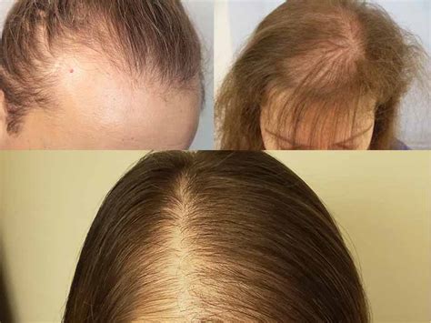 what is female pattern baldness definition cause and solution
