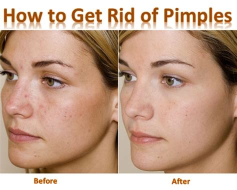 rid  pimples fast active home remedies