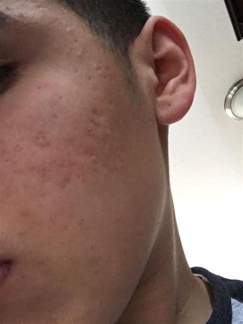 what type of acne scars do i have and what s the best treatment in your