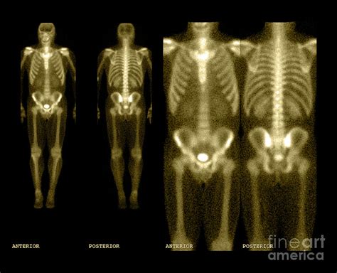 bone scan  photograph  medical body scans fine art america