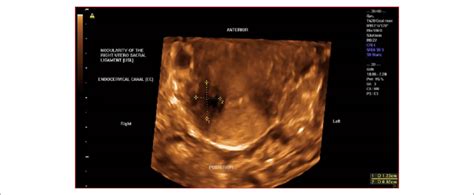 3dtvs rendering mode of the transverse view of the cervix demonstrating