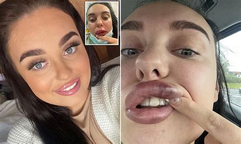 dental nurse 21 claims she almost went blind and lost her lip after