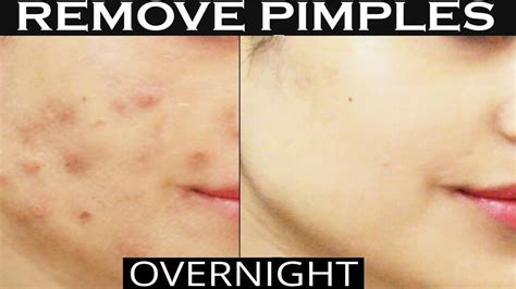 how to remove pimples overnight acne treatment remove