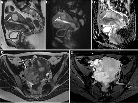 Magnetic Resonance Imaging Mri Shows A Leiomyoma In The Posterior